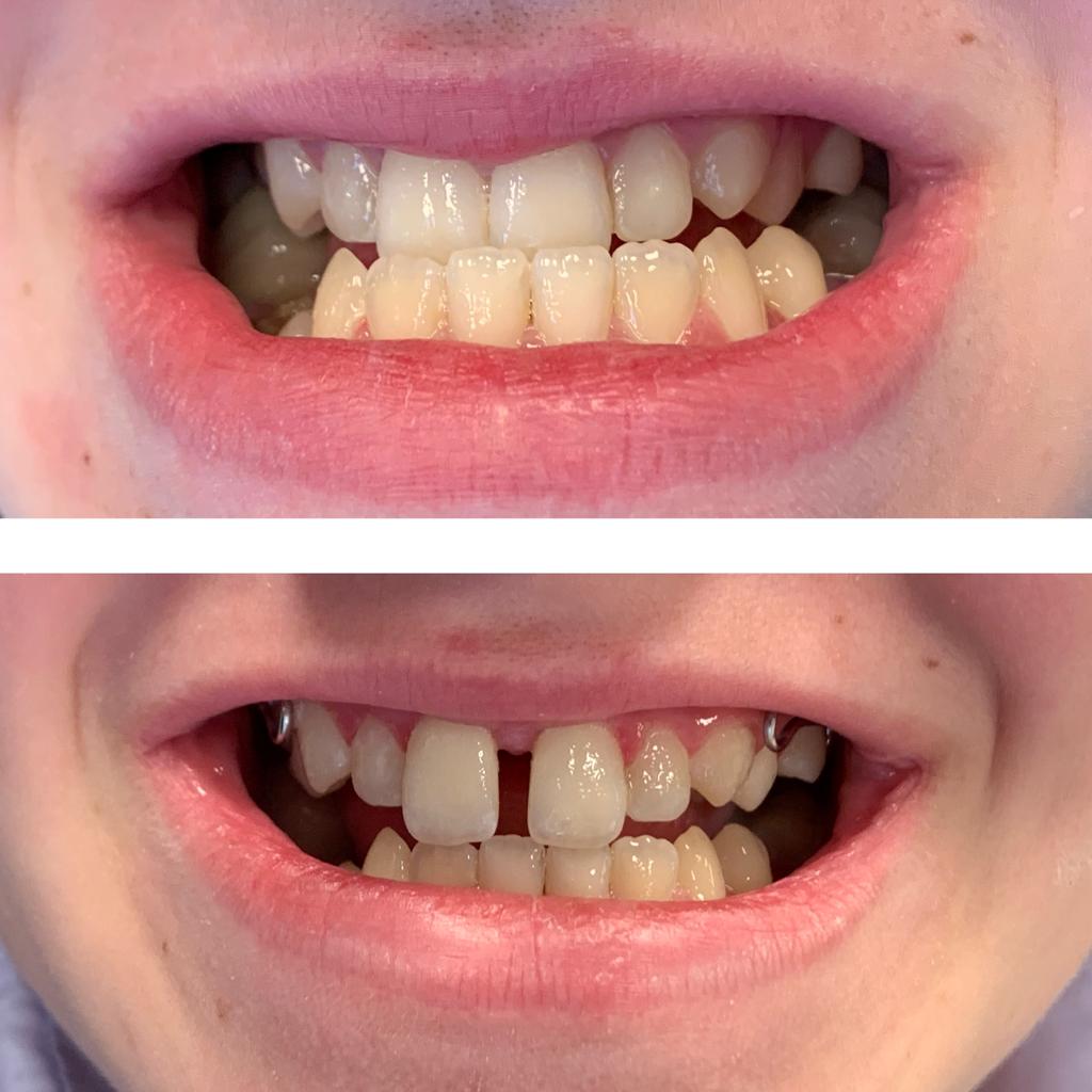 Treated case