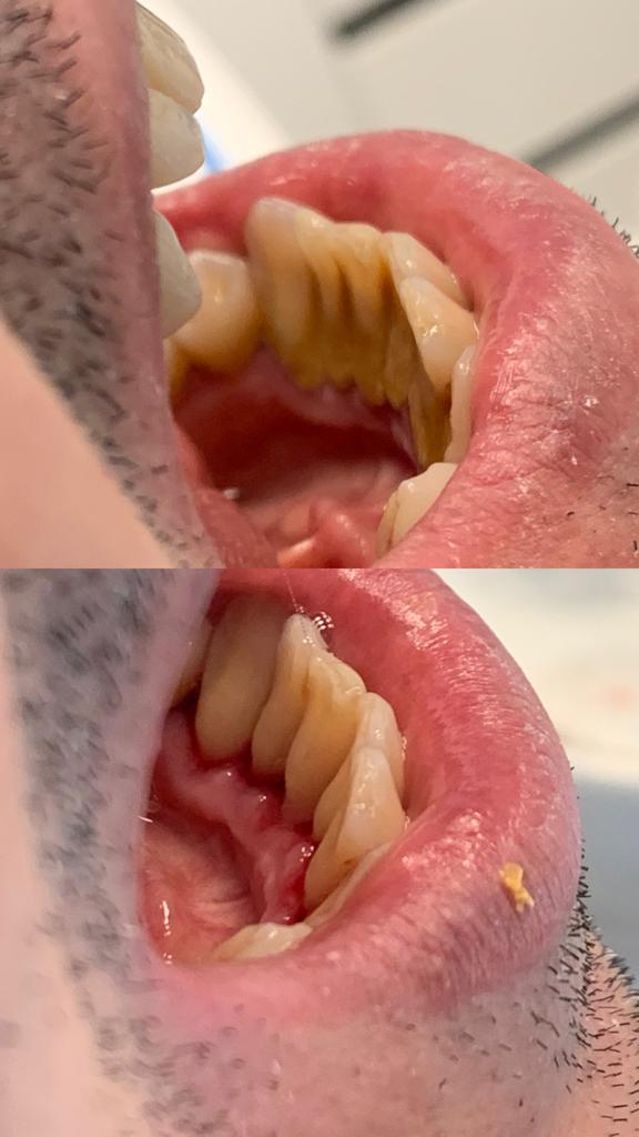 Treated case