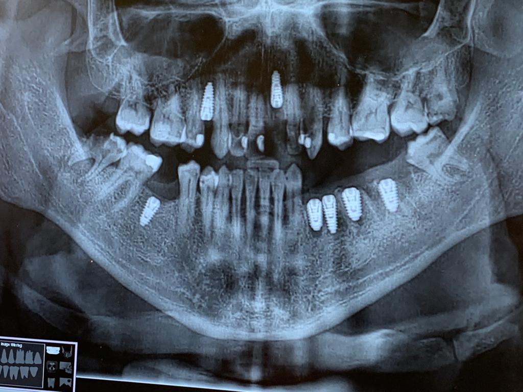 Treated case